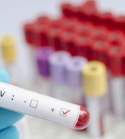 Blutprobe mit der Aufschrift HIV positiv.