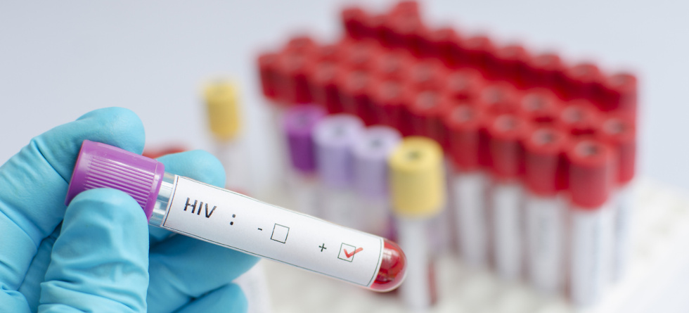 Blutprobe mit der Aufschrift HIV positiv.