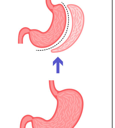 Illustriertes Bild. Patient (links) und Arzt (rechts). In der Mitte eine Illustration einer Magenverkleinerung.