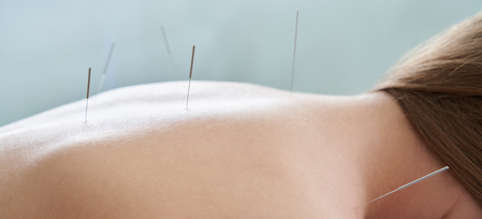 Weiblicher Rücken mit Nadeln bei der Akupunktur-Behandlungstherapie.