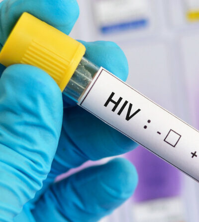 HIV-positive Blutprobe