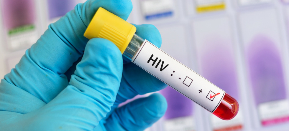 HIV-positive Blutprobe